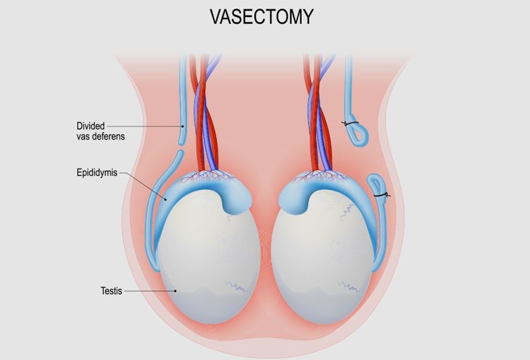 Is pregnancy possible after a vasectomy?