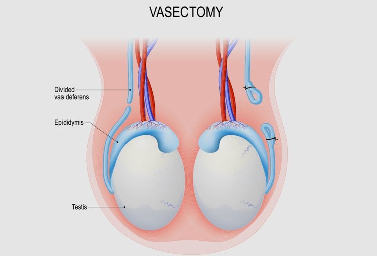 Is pregnancy possible after a vasectomy? Is pregnancy possible after a vasectomy?